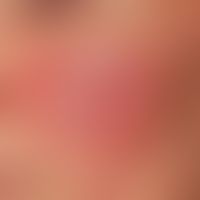Rosacea erythematosa:&nbsp; flächenhafte und gleichmäßige Rötung beider Wangen. Wechslehafter&nbs...
