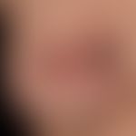 Keratoakanthom (Typ Riesenkeratoakanthom): 4 cm im Durchmesser großer, schmerzloser Knoten mit pe...