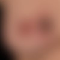 Keratoakanthom (Typ Riesenkeratoakanthom): 4 cm im Durchmesser großer, schmerzloser Knoten mit pe...