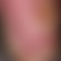 Rhagade: querverlaufende tiefe schmerzhafte Rhagaden bei schwerer Psoriasis plantaris.
