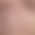 Mononucleosis infectious: acutely occurring, slightly itchy, maculo-papular exanthema, accompanie...