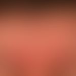 Rosacea papulopustulosa: detailed picture, partially small scaly erythema interspersed with folli...