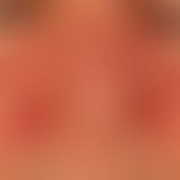 Lupus erythematosus acute-cutaneous: symmetrical red spots, patches and plaques on the face that ...