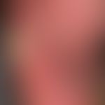 Schwiele: umschriebene Druckschwiele bei diabetischer Polyneuropathie. Flächiges Erythem der Fußs...