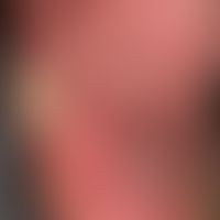 Schwiele: umschriebene Druckschwiele bei diabetischer Polyneuropathie. Flächiges Erythem der Fußs...
