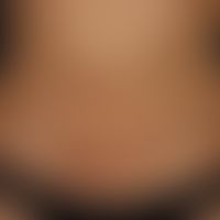 Circumscribed scleroderma (plaque type): for about 2 years first occurring, since then progressiv...