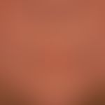 Scleroderma, systemic: taut, shiny facial skin (see chin region); distinct perioral fibrosis, whi...