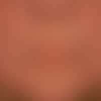 Scleroderma, systemic: taut, shiny facial skin (see chin region); distinct perioral fibrosis, whi...