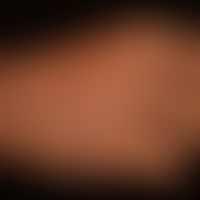 Scleroderma, systemic (sclerosis of the hands): Raynaud's syndrome, known since puberty, palmar h...