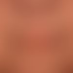 Scleroderma, systemic: slightly taut facial skin (see perioral region) distinct perioral fibrosis...
