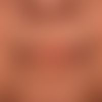 Scleroderma, systemic: slightly taut facial skin (see perioral region) distinct perioral fibrosis...