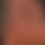 scleroderma systemic: redness and slight blue discoloration (much more pronounced when exposed to...