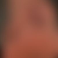 scleroderma systemic: redness and slight blue discoloration (much more pronounced when exposed to...
