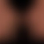 Scleroderma systemic: edematous swelling of the hands and fingers. when stretching the fingers, w...