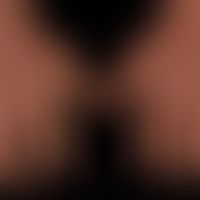 Sklerodermie systemische:&nbsp;ödematöse Schwellung der Hände und Finger. Beim Spannen der Finger...
