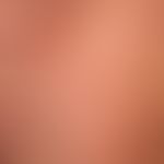 Scleroderma, systemic: within a few years, newly developed telangiectasia of the facial skin in p...