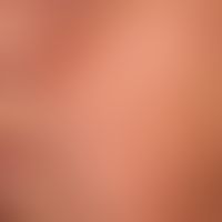 Scleroderma, systemic: within a few years, newly developed telangiectasia of the facial skin in p...