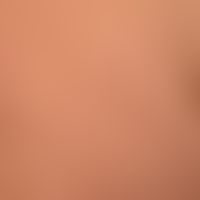 Teleangiectasia macularis eruptiva perstans: discrete, moderately itchy, disseminated, 0.2-0.5 cm...