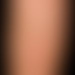 Urticaria chronic spontaneous: multiple, chronically recurrent, reddish, partly confluent wheals,...