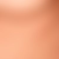 Urtikaria&nbsp;chronische spontane:&nbsp;multiple, chronisch rezidivierende, rötliche, teils konf...