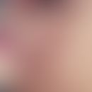 Pseudo-Köbner-Phänomen: Anordnung von planen Warzen in Kratzspuren.
