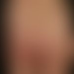 Naevus flammeus: angeborener, asymmetrisch angelegter, syndromaler (orthopädische Fehlstellung)&n...