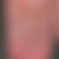 Varikose primäre: sog. Fingervarizen. "Erworbene" vaskuläre Malformation der Fingervenen. &nbsp;

