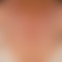 Vitiligo (Detailaufnahme): therapieinduzierte (nach Gabe eines Checkpoint Inhibitors) Vitiligo be...