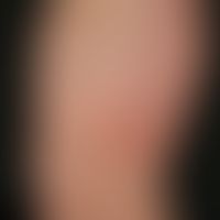 Still Syndrome adultes: maculo-papular (sometimes urticarial aspect) exanthema in 53-year-old pat...