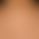 Pseudoacanthosis nigricans: symmetrical, brownish, moderately sharply defined, poorly elevated, c...