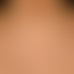 Pseudoacanthosis nigricans: symmetrical, brownish, moderately sharply defined, poorly elevated, c...