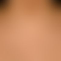 Pseudoacanthosis nigricans: symmetrical, brownish, moderately sharply defined, poorly elevated, c...