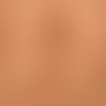 Pseudoacanthosis nigricans: symmetrical, brownish, moderately sharply defined, poorly elevated, c...