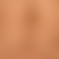 Pseudoacanthosis nigricans: symmetrical, brownish, moderately sharply defined, poorly elevated, c...