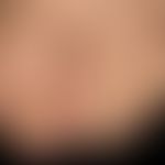 Onychogrypose (komplikativ überlagert): mäßig stark ausgeprägte Onychogrypose bei einer 18-jährig...