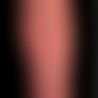 Pustulose, akute generalisierte exanthematische: akut aufgetretenes erythrodermisches Exanthem mi...