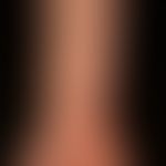 Lichen planus pigmentosus: brownish, elongated to oval, shiny plaques, as partial manifestation o...