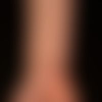Lichen planus pigmentosus: brownish, elongated to oval, shiny plaques, as partial manifestation o...