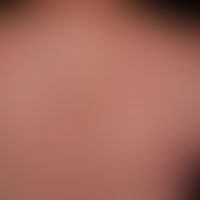 Urtikaria&nbsp;chronische spontane:&nbsp;multiple, chronisch rezidivierende, rote, teils konfluie...