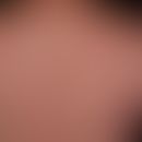 Urtikaria&nbsp;chronische spontane:&nbsp;multiple, chronisch rezidivierende, rote, teils konfluie...