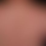 Urticaria chronic spontaneous: multiple, chronically recurrent, red, partly confluent wheals, wit...