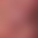 Urticaria chronic spontaneous: recurrent exanthema existing since half a year, with multiple, red...