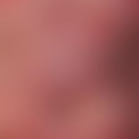 Urticaria chronic spontaneous: recurrent exanthema existing since half a year, with multiple, red...