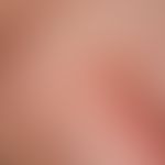 Xanthogranulom juveniles (sensu strictu).&nbsp;Weich elastische, gelbliche, vollkommen symptomlos...