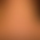 Acanthosis nigricans benigna: unscharf begrenzte braun-schwarze Flecken, stellenweise auch Plaque...