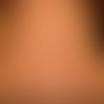 Acanthosis nigricans benigna: unscharf begrenzte braun-schwarze Flecken, stellenweise auch Plaque...