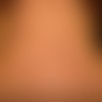 Acanthosis nigricans benigna: unscharf begrenzte braun-schwarze Flecken, stellenweise auch Plaque...