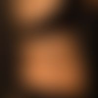 Acanthosis nigricans benigna: unscharf begrenzte braun-schwarze, stellenweise verruköse Plaques. ...