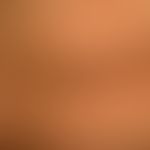 Acanthosis nigricans benigna: unscharf begrenzte braun-schwarze Flecken und Plaques. Die Plaques ...