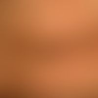 Acanthosis nigricans benigna: blurred brown-black spots and plaques. the plaques are characterize...